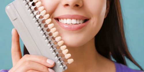 faccetta dentale blog Protesica