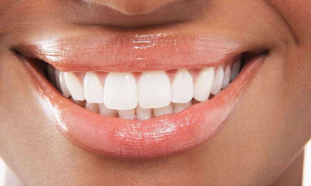 Quanto dura lo sbiancamento dentale