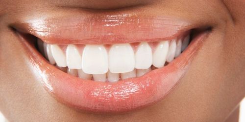 Quanto dura lo sbiancamento dentale