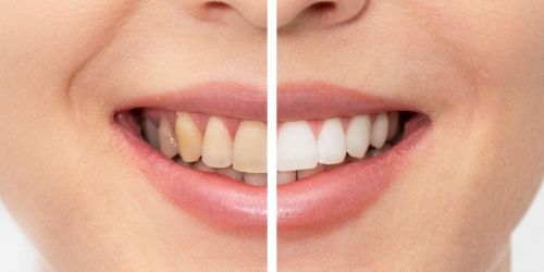 sbiancamento denti