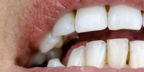 Pulizia dentale tartaro