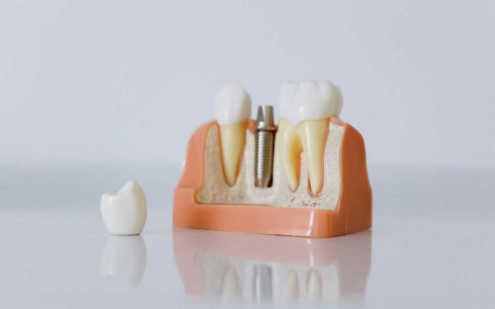 Implantologia dentale