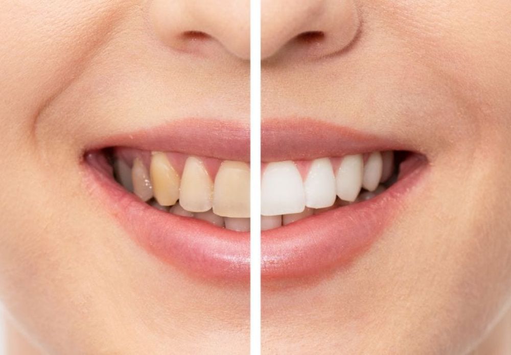 sbiancamento denti