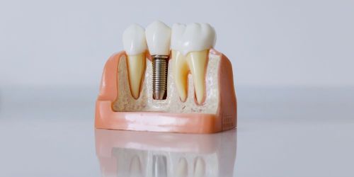 impianto dentale protesica